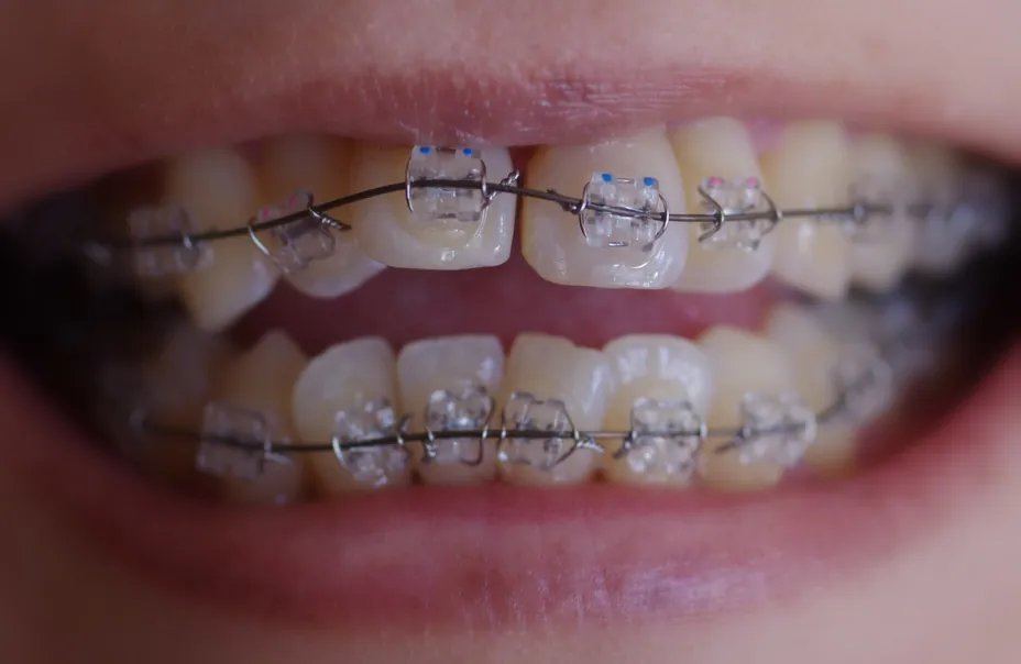 Ortodoncia con brackets en Reinadent, Estepa