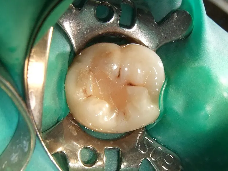 Odontología conservadora en Reinadent, Estepa