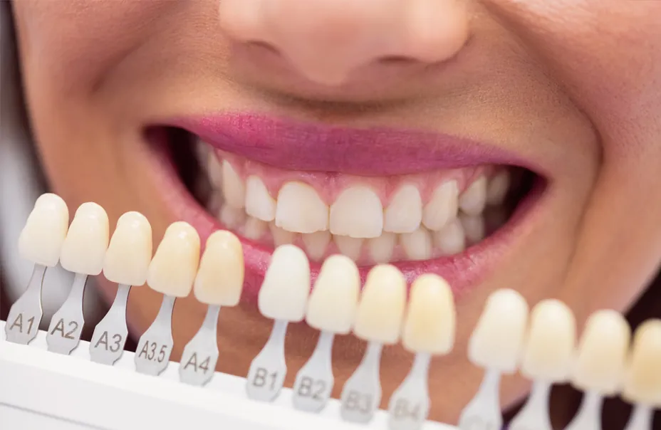 Estética dental en Reinadent, Estepa