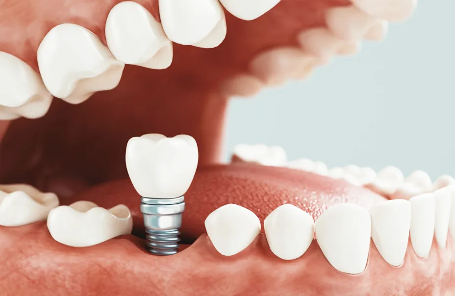 Implantes dentales en Reinadent, Estepa